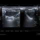 Lung infarction: US - Ultrasound